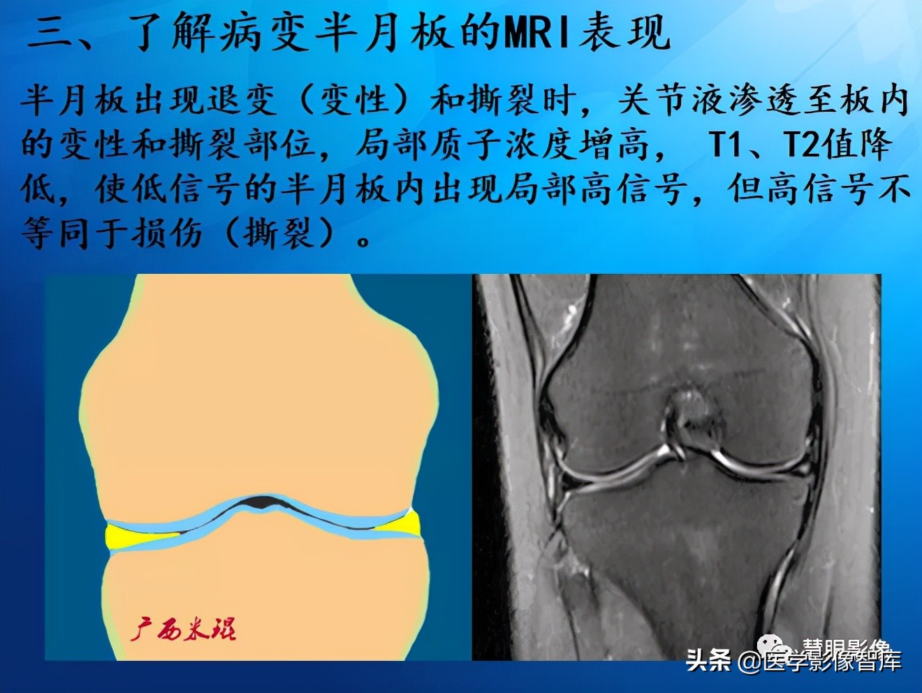 膝关节半月板损伤的解剖结构图,半月板mri解剖图解