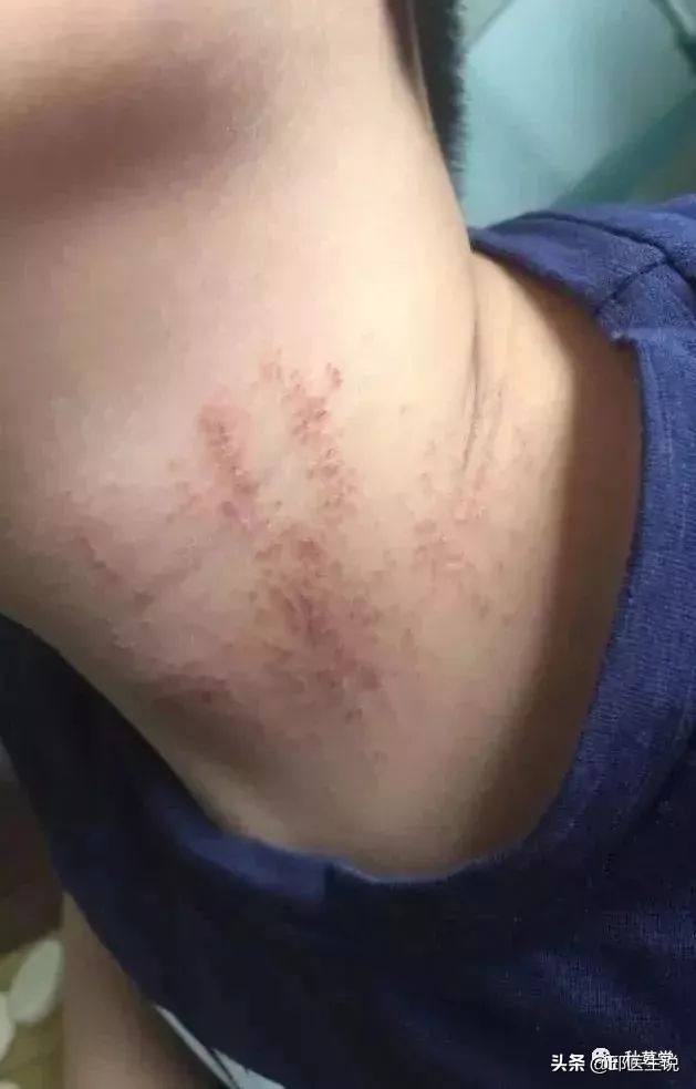 皮肤瘙痒的外洗中药,中药外洗治疗顽固性皮肤瘙痒