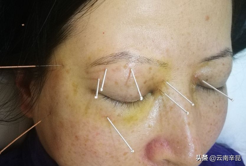 单侧突眼症中医针灸治疗案例