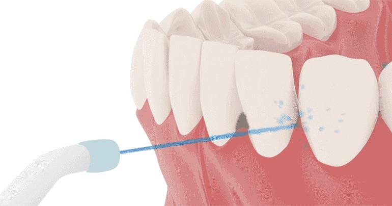 天天宅家胡吃海塞,水牙线比电动牙刷更靠谱!用过的都知道