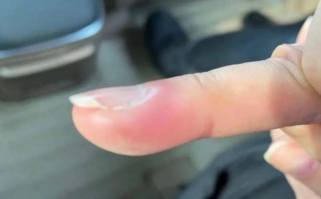 手上起倒刺缺乏什么维生素,手上倒刺最简单的去除方法