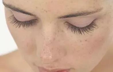 欧美美白祛斑,欧美祛斑美白