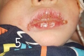 国外宝宝被邻居亲吻后中毒,婴儿被亲嘴感染什么症状