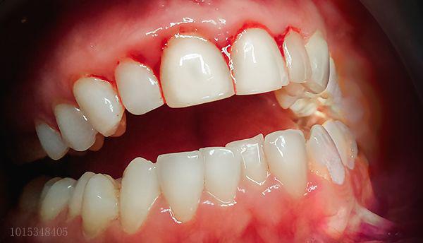 三度松动的牙齿治不好了吗,口腔科是如何修复松动的牙齿