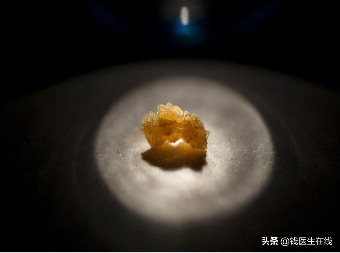 肾结石怎么才能消净,肾结石如何彻底解决问题