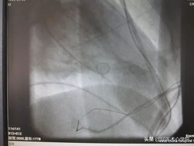 肥厚性心肌病伴心肌梗死,心尖部室壁瘤和心肌穿孔能救活吗