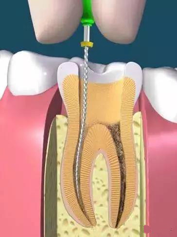 牙齿上面有黑线但是没有洞怎么办,牙齿咬合面有黑线没有洞怎么治疗