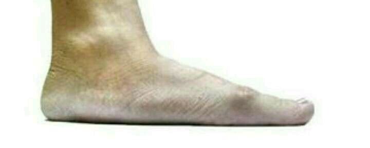 马蹄内翻畸形是扁平足吗,儿童畸形的表现