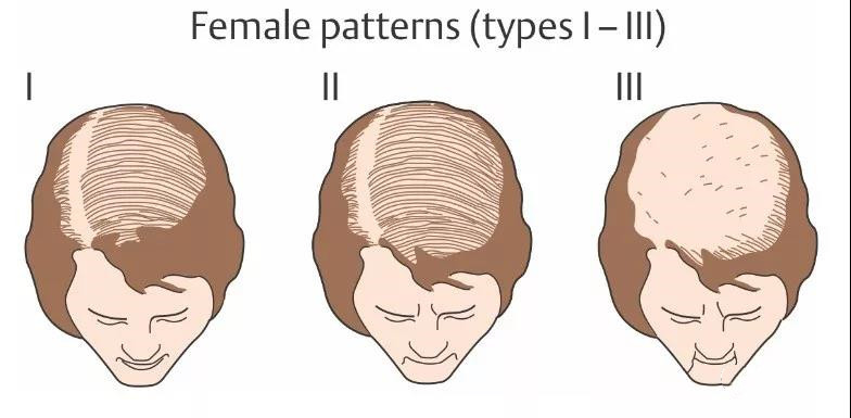 脱发的正确治疗方法和注意事项,脱发的常见类型与防治