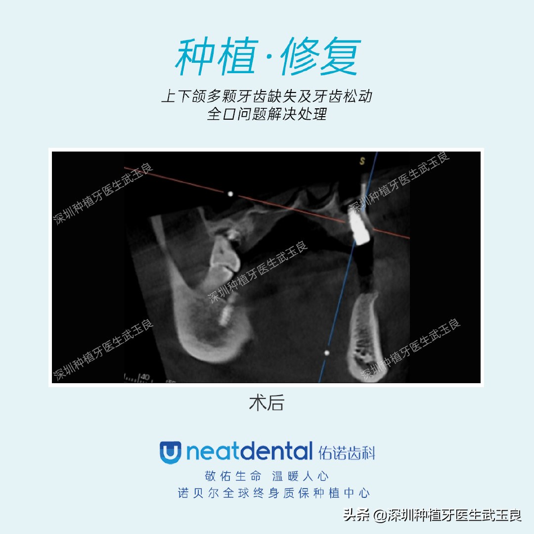 多颗牙齿缺失怎么修复全过程,多颗缺失牙修复案例