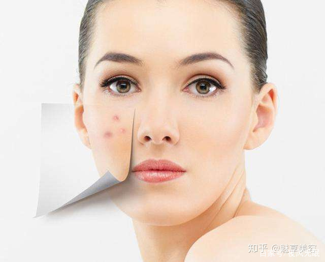 胸前背后长痘痘怎么解决,脸上长痘痘发红怎么解决