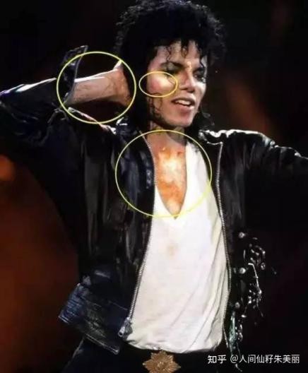 脸上长斑是激光还是用祛斑产品好,50岁年龄脸上长斑怎样能祛斑