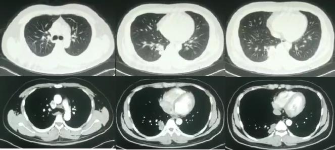肺部陈旧病灶会变大么,肺部病灶1.2厘米严重吗