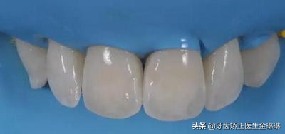 为什么河北人容易有氟斑牙,中国哪些地区会有氟斑牙