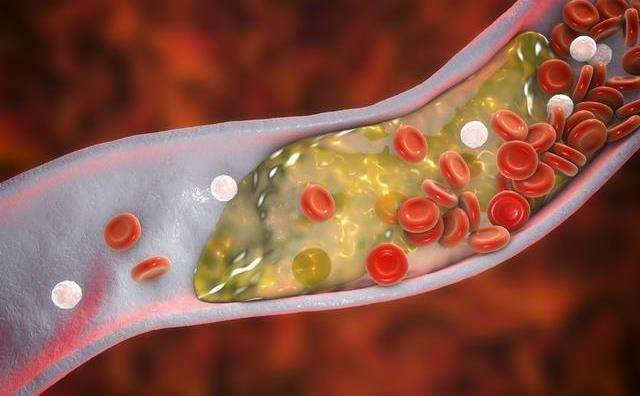 痛风合并高血压怎么预防,痛风合并其他疾病怎么治