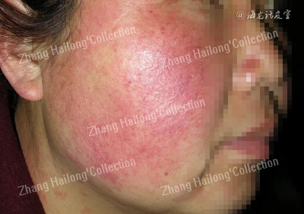 激素依赖性皮炎饮食注意事项,激素依赖性皮炎用什么护肤品