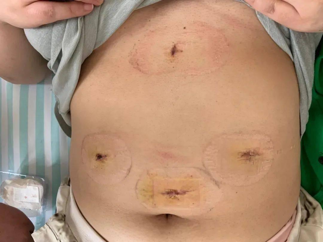 男子切胃,男子做切胃手术