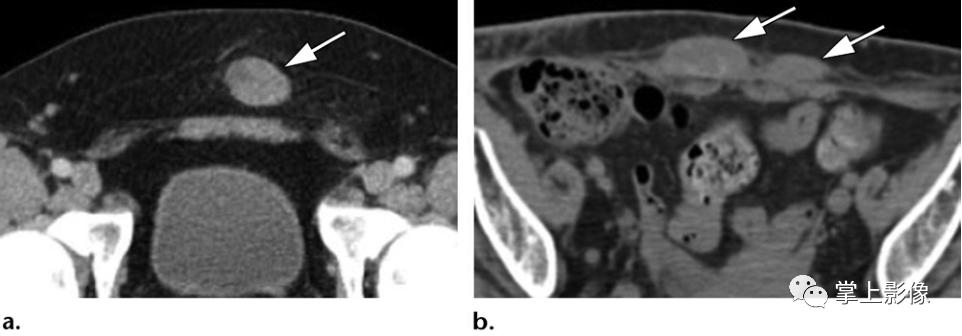 腹壁病变诊断思路,腹部影像诊断读片入门视频