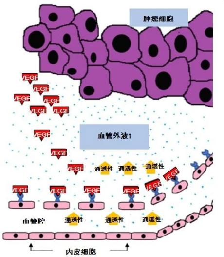 肺癌晚期有恶性胸腔积液,胸腔积液恶性是什么意思