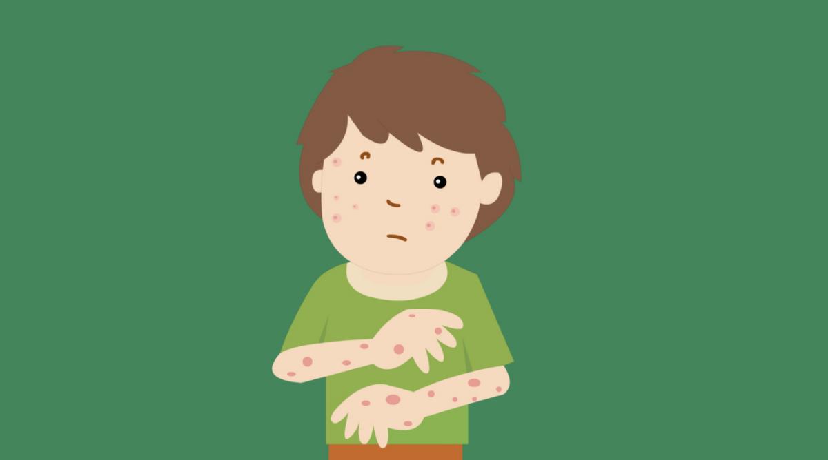 什么是过敏性紫癜症状,过敏性紫癜什么症状怎么治疗