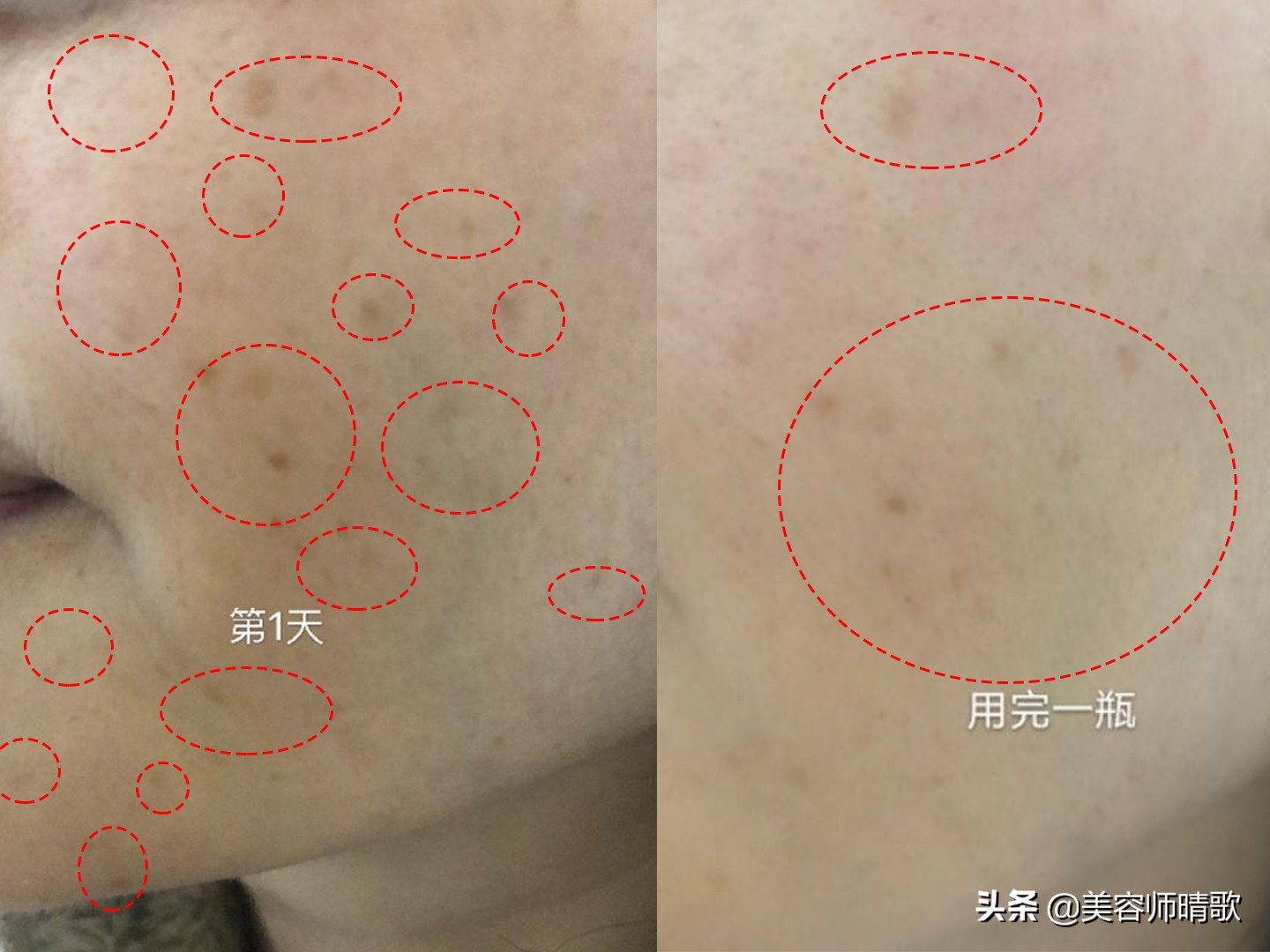 淡斑小白瓶精华二代,小白瓶美白淡斑护肤品推荐