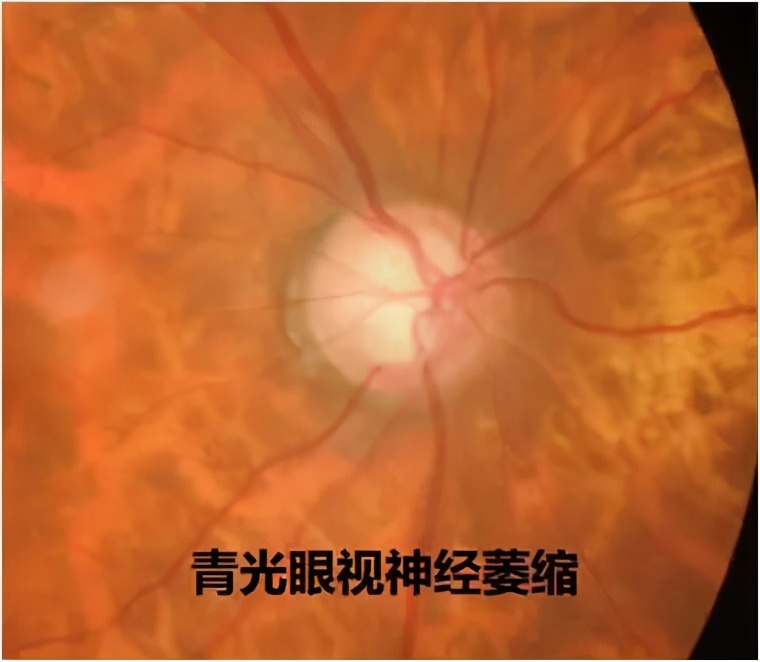 眼底刚查正常但突然有飞蚊症,眼病早知道的症状