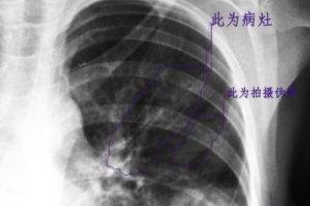 儿童肺炎支原体感染的症状和表现,宝宝肺炎支原体感染最有效的方法