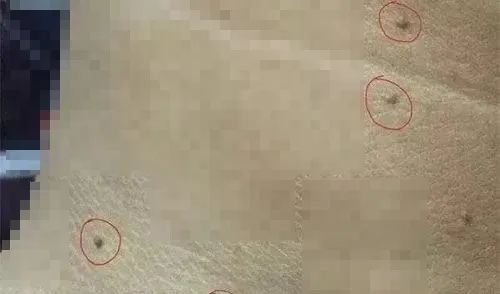 6岁儿童丝状疣怎么治疗,小孩子得寻常疣是什么原因造成的