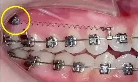 矫正牙齿打支抗钉亲身经历,矫正支抗钉一般打哪个位置