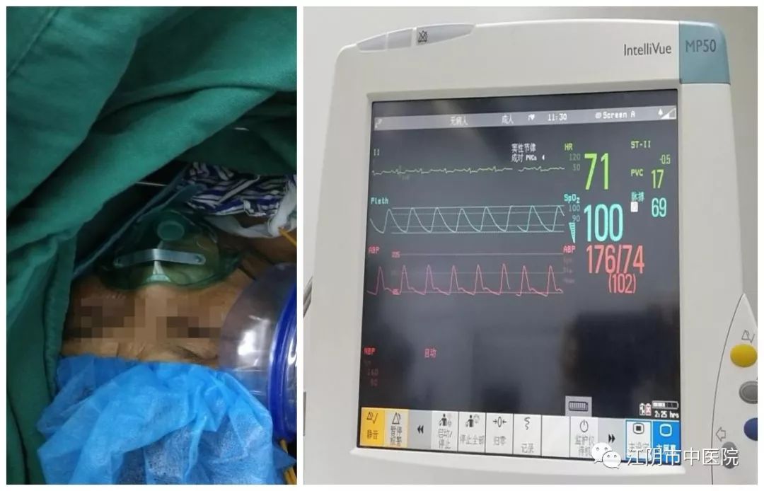 江阴：这些麻醉师真棒！一名尿毒症患者行超声引导下臂丛神经阻滞麻醉获得成功