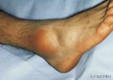 陈旧性踝关节损伤的治疗,踝关节损伤现场处理视频