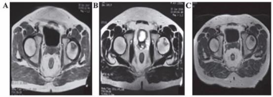 干细胞治疗帕金森病最新消息,2022年世界帕金森日主题视频