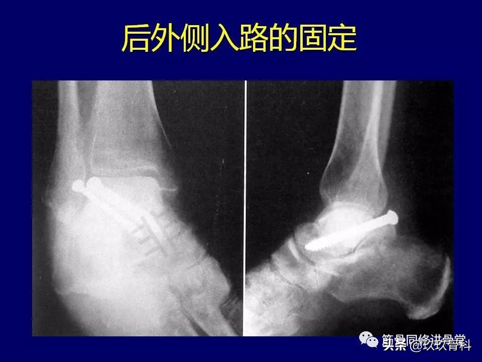 距骨骨折后遗症,距骨骨折怎么办