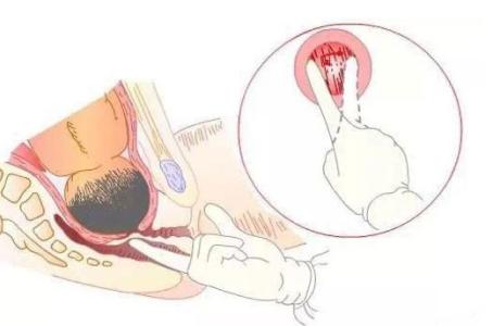 顺产好还是剖腹产好该怎么选择,顺产和剖腹产到底怎么选