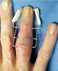 手指打篮球挫伤一个月还没好,手指打篮球挫伤了