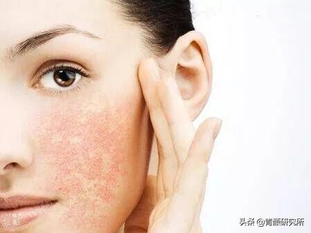 修复角质层薄红血丝敏感肌软膜,修复角质层薄红血丝敏感肌妙招