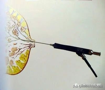 什么叫乳管镜检查,乳管镜检查操作与步骤