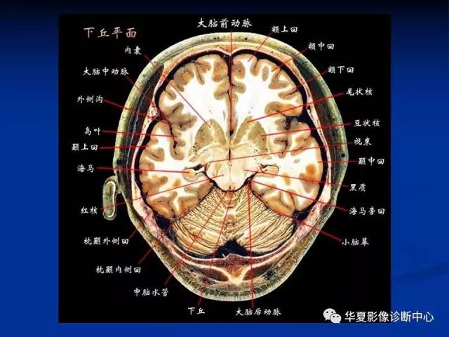 电子版头颅ct与mri断层解剖,头颅mri血管解剖与分段详解