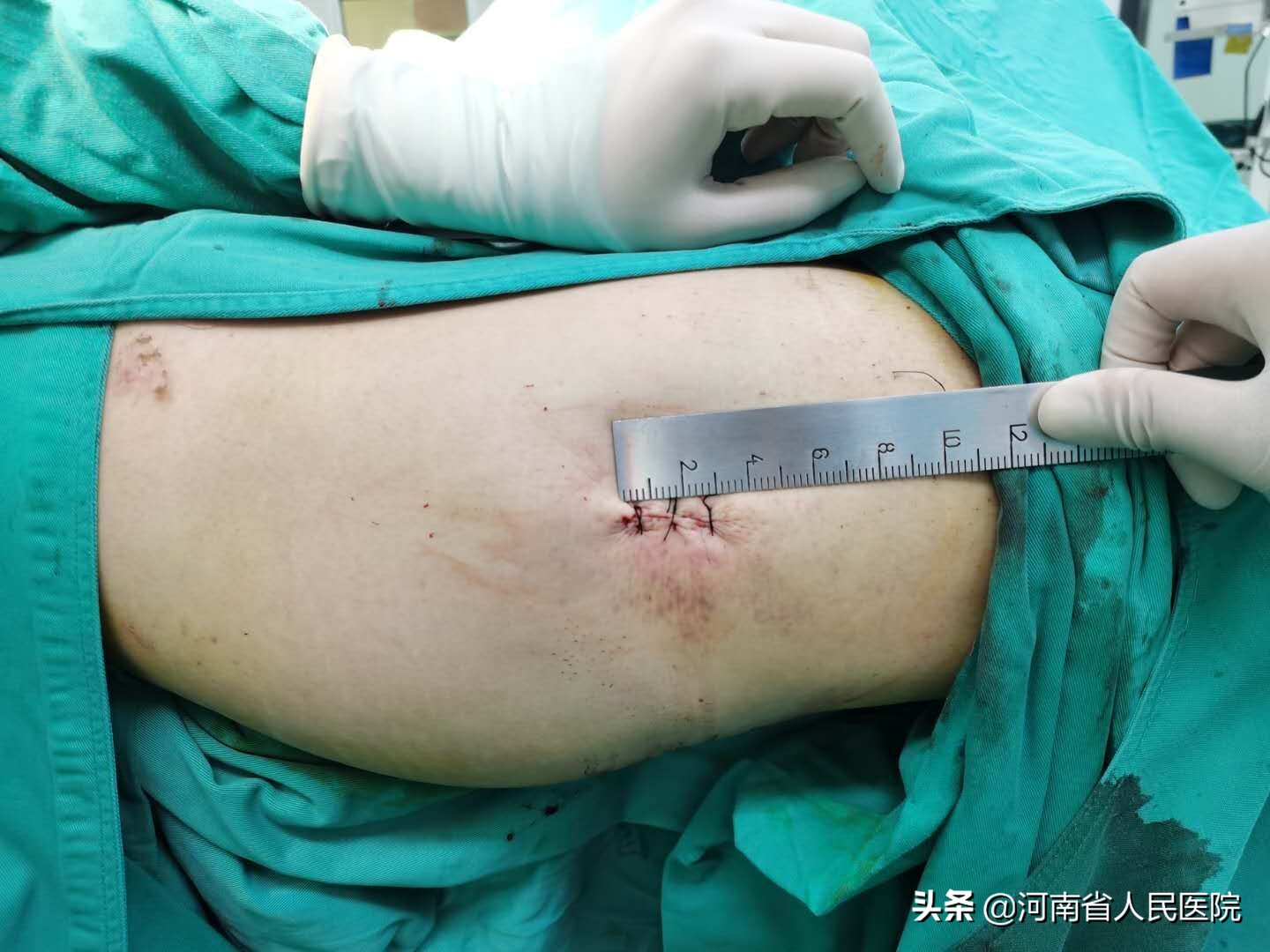 河南省人民医院协作院区,河南省人民医院做腰椎骨折手术