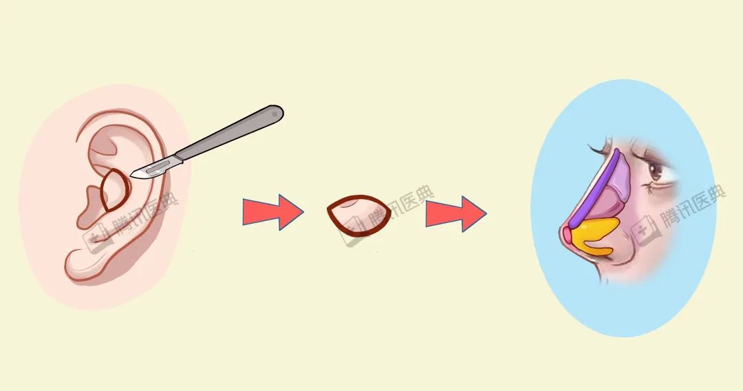 隆鼻的几大风险,隆鼻真的10个做9个后悔吗