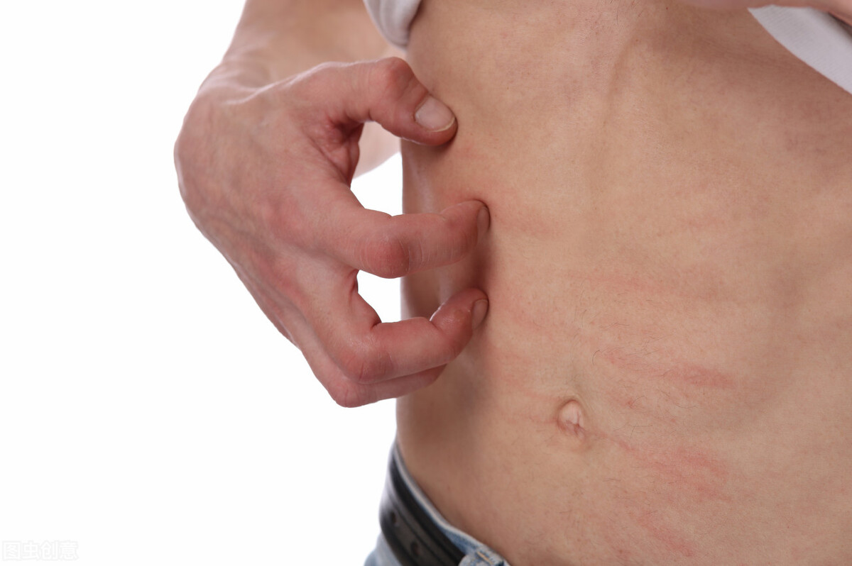 有湿疹可以用当归和黄芪泡水喝吗,血虚风燥引起湿疹吃什么中成药