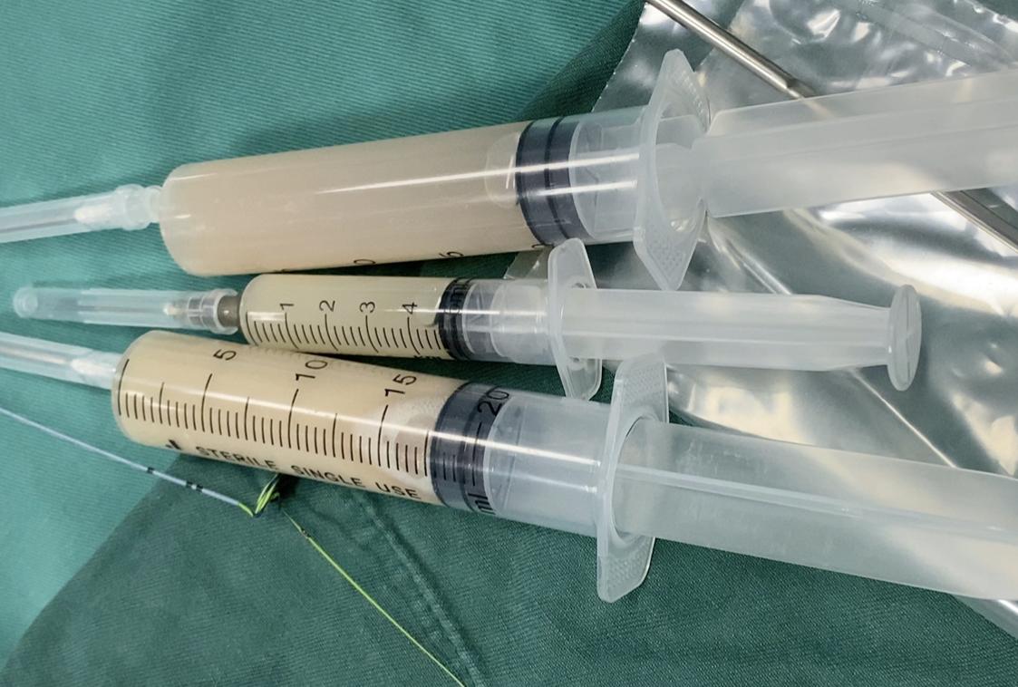 最新输尿管结石的治疗方法,输尿管结石的药物治疗