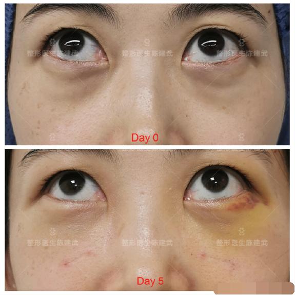 做完眼袋手术有淤青发黑怎么回事,做完眼袋手术有淤青图片