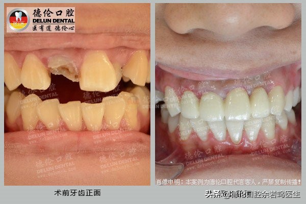 现在修复牙齿有哪几种类型的牙,牙齿修复的几种方法和价格
