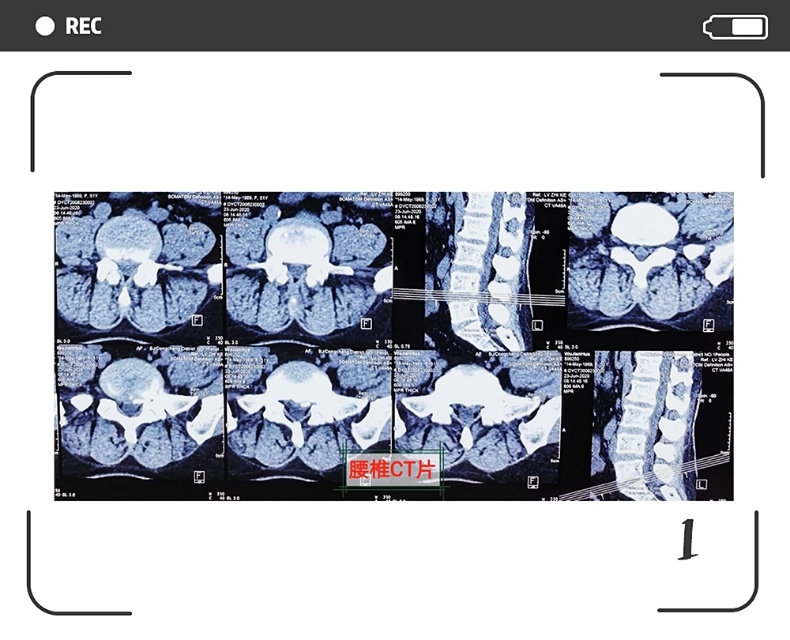 专家治疗腰椎间盘突出症的手法,专家教你快速治疗腰椎间盘突出