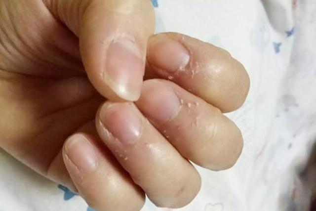 指甲周围长倒刺用什么药,指甲周围长倒刺是缺维生素吗