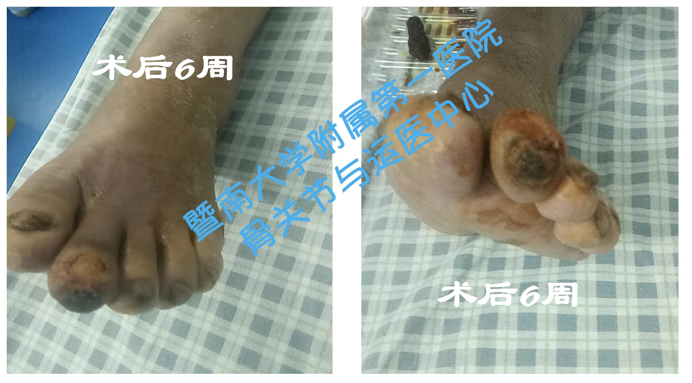 糖尿病足截肢后怎么长肉快,糖尿病足不截肢的最新疗法