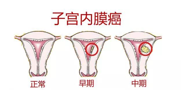 每月都来大姨妈还会导致不孕吗,大姨妈的风险