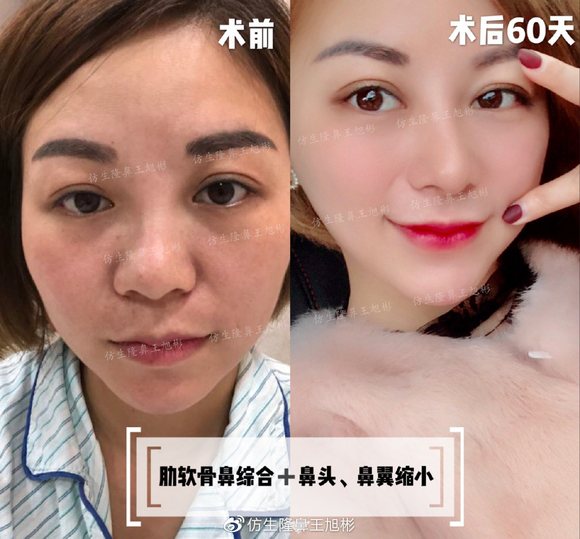 短鼻蒜头鼻整形,短鼻延长术切口