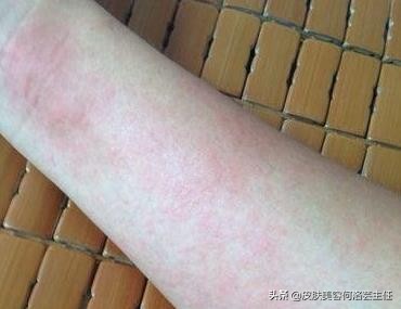 慢性荨麻疹治好了还需要忌口吗,麻疹怎么解释